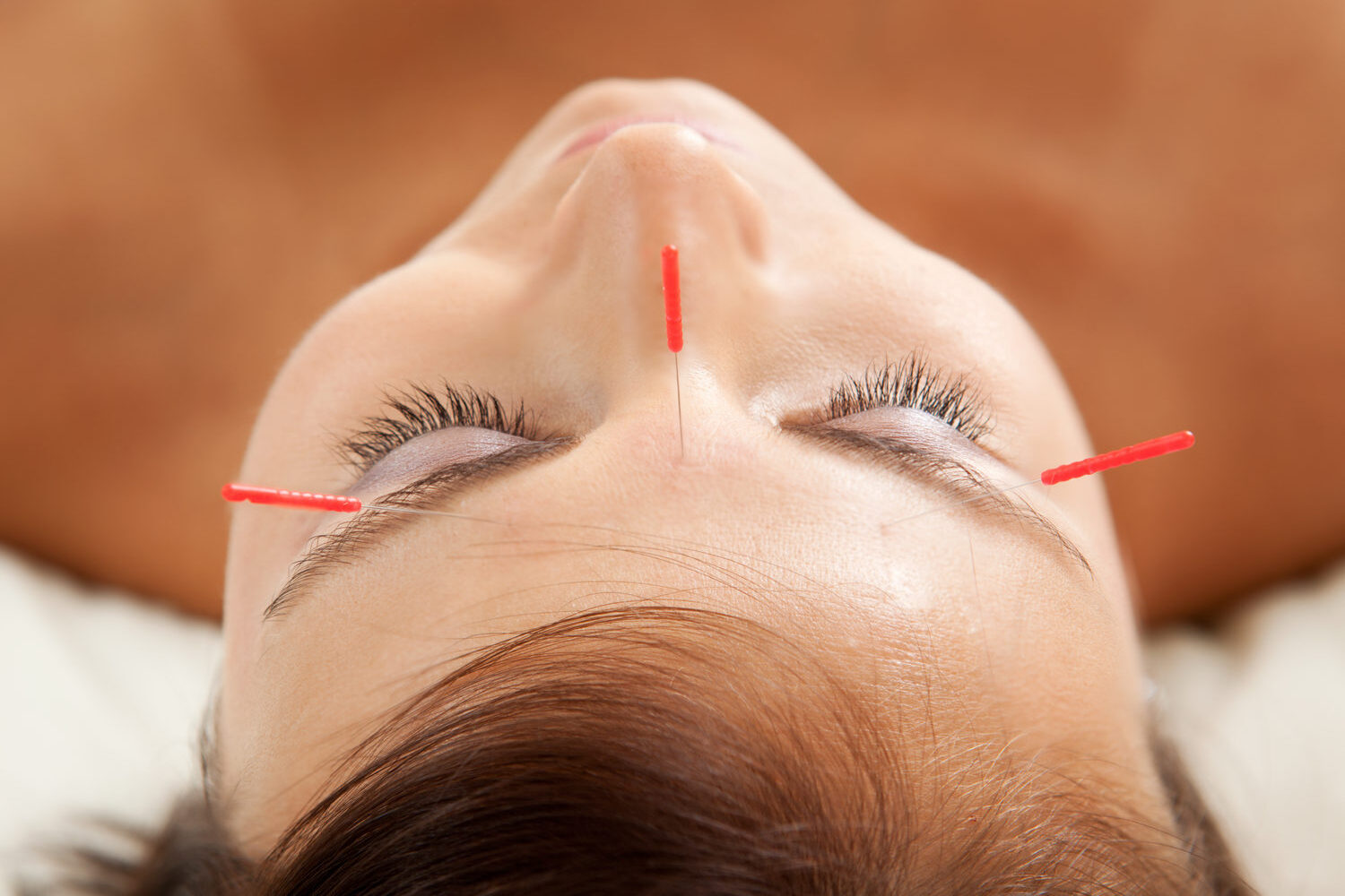 Anti-aging,Acupuncture,Treatment,On,Young,Attractive,Female,Patient