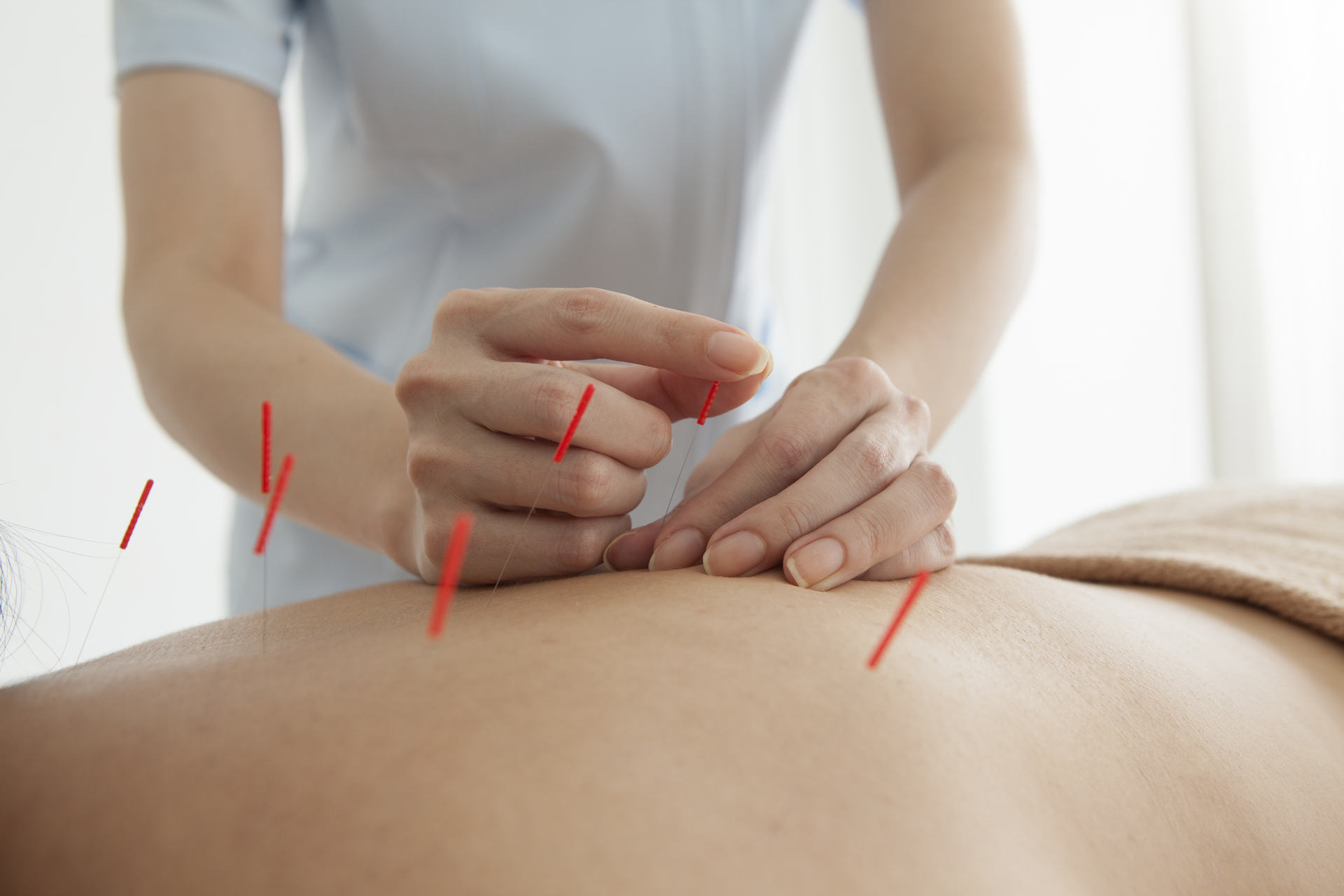 The Perks of Acupuncture for Pain Relief