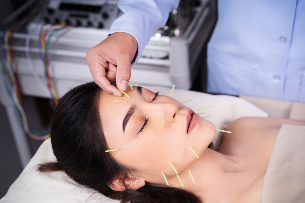 The Benefits of Facial Acupuncture